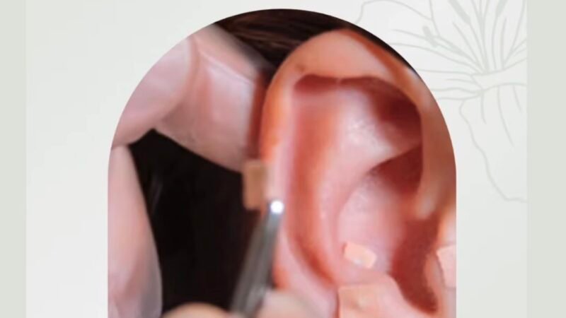 Gestão Paulo Roberto amplia cuidado com a saúde e oferece auriculoterapia gratuita em Vitória de Santo Antão