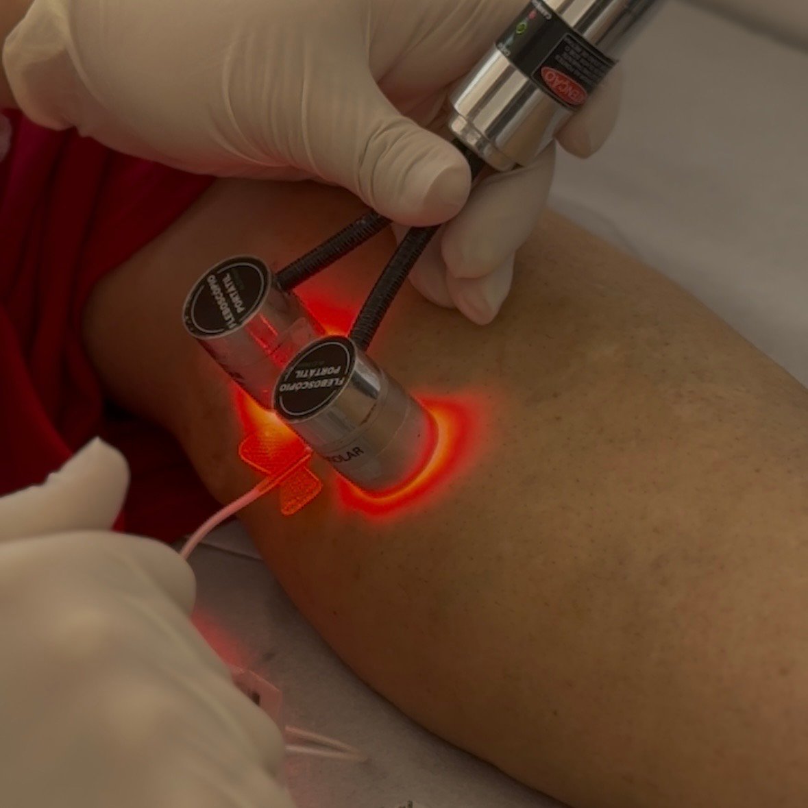 Prefeitura de Casa Nova amplia oferta de serviços de saúde e atende mais de 130 mulheres com escleroterapia